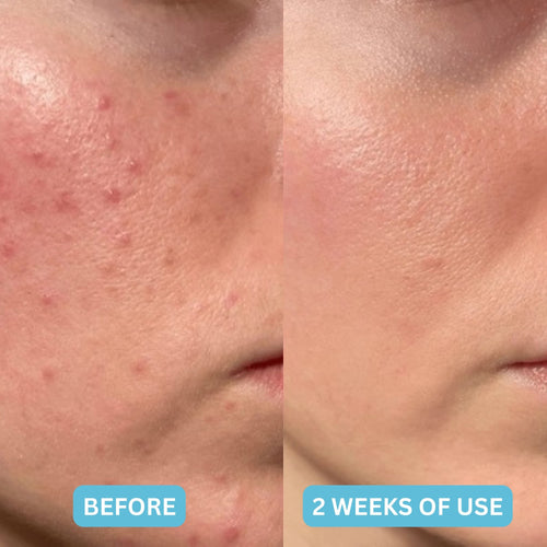 Hydrocolloid Skin Healing Roll